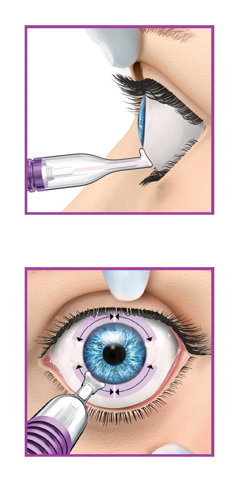 Placement of MicroPulse P3 Glaucoma Device